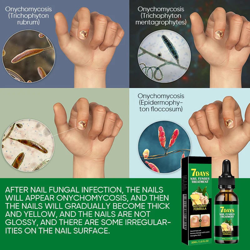 Tratamiento de uñas de jengibre