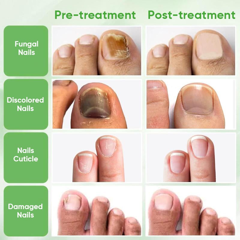 Tratamiento de uñas de jengibre