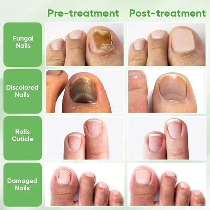 Tratamiento de uñas de jengibre